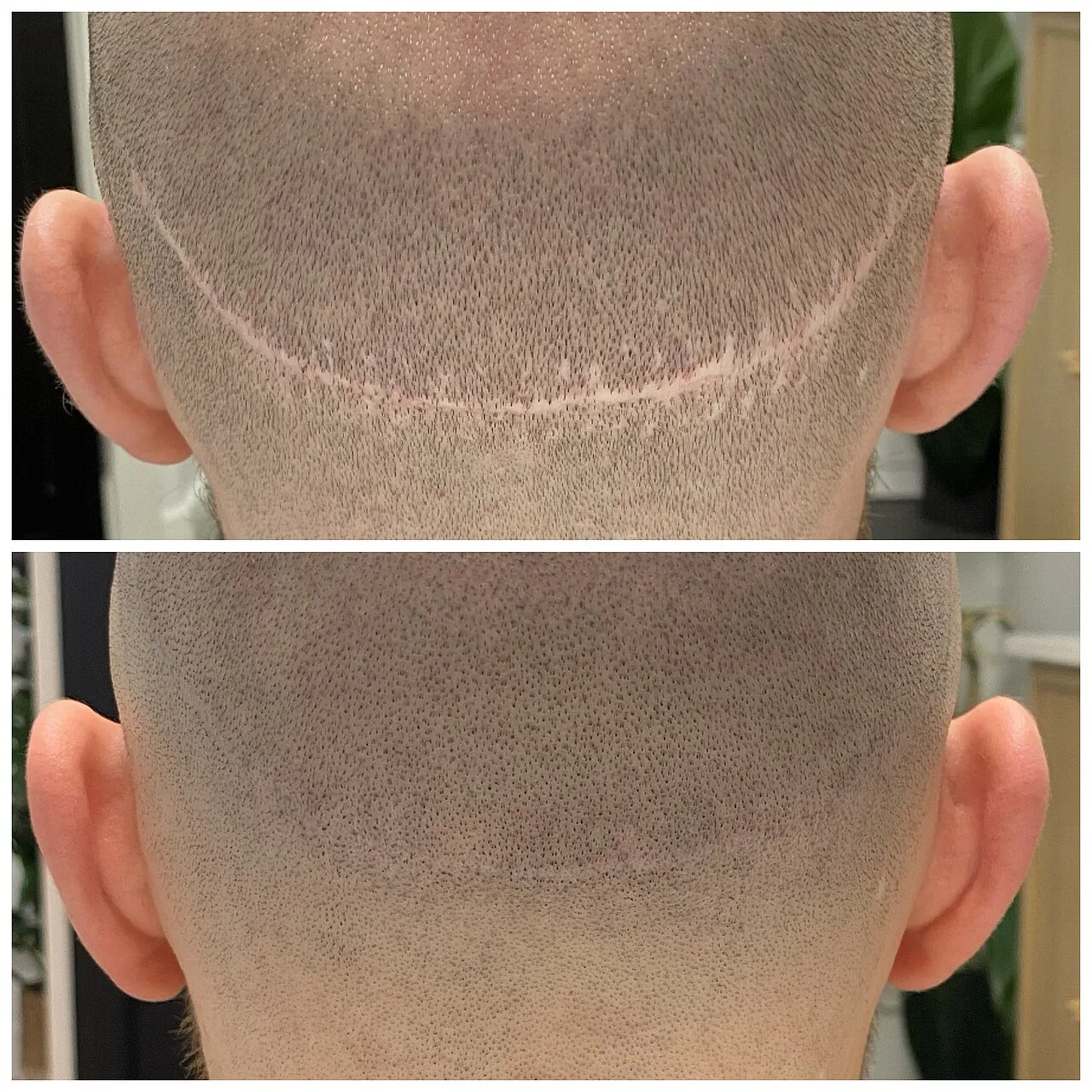 Hair loss